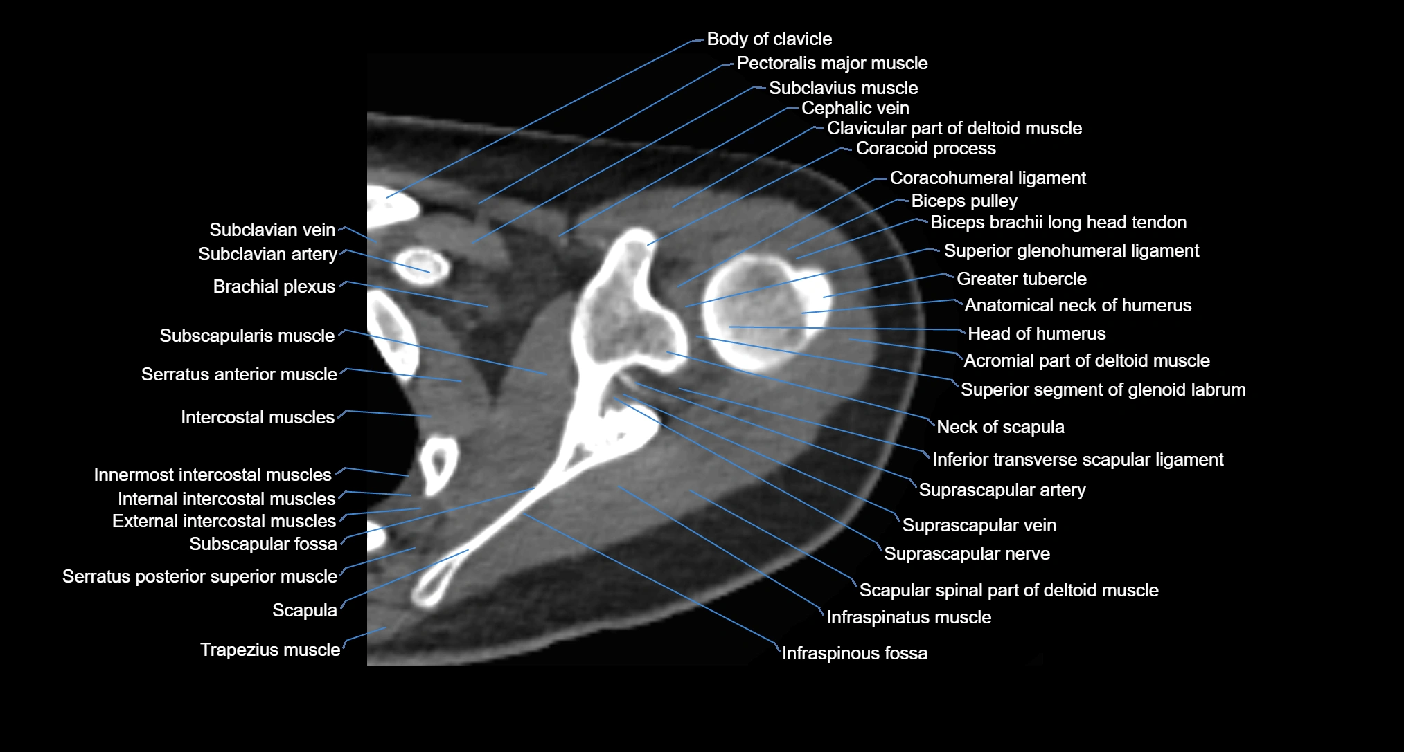 CT Shoulder axial cross sectional anatomy labelled radiology image -00025.webp